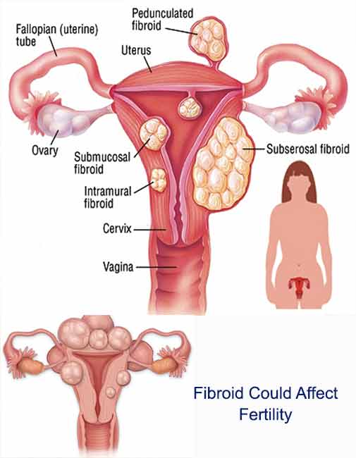 things you should know about fibroid and fertility