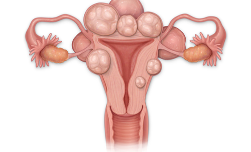 Fibroid