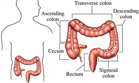 colon cancer