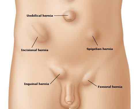 hernia and things you should know