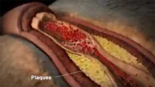 Plaque can stay around the arteries 