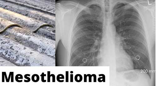 Mesothelioma cancer caused by exposure to asbestos