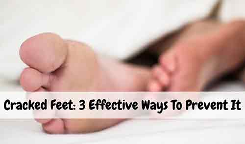 3 effective ways to prevent cracked feet