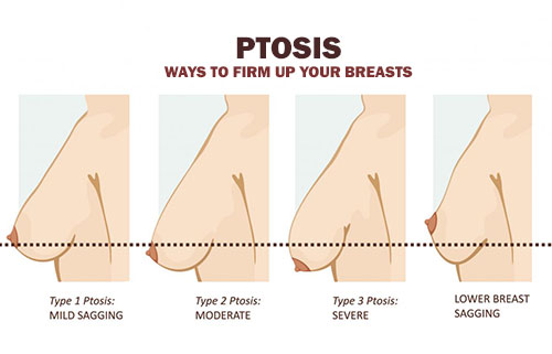 sagging breasts and ways to firm up your breasts