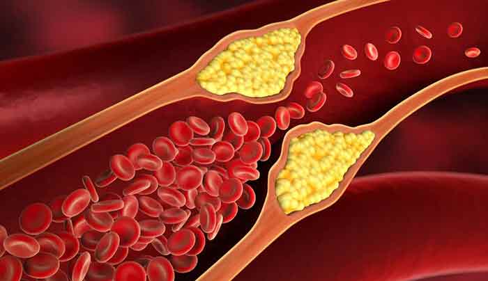 high cholesterol bad cholesterol and how to lower cholesterol Level. How To Reduce Cholesterol Level