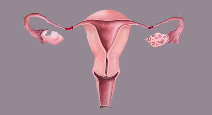 Fallopian Tube Blockage. Pelvic Adhesion Natural remedies