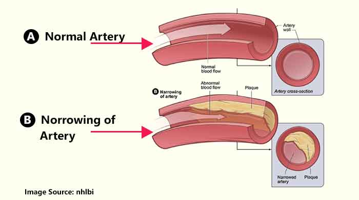 What Is Atherosclerosis. Symptoms Of Atherosclerosis