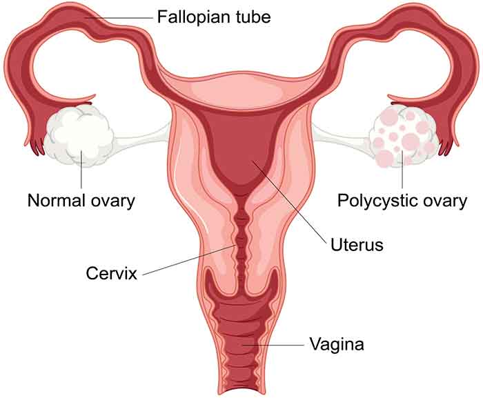 PCOS stands for Polycystic Ovary Syndrome and What Is Hyperandrogenism In PCOS